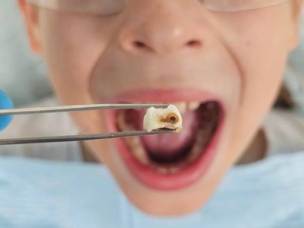 Best Emergency Dentist for Lost Fillings or Crowns in Pompano Beach, FL